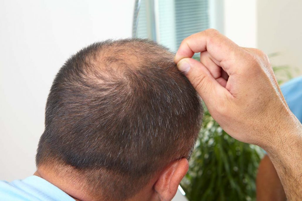 5 Ways to Recover From Hair Loss and Look Your Best