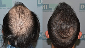 Before and After Signs of Balding