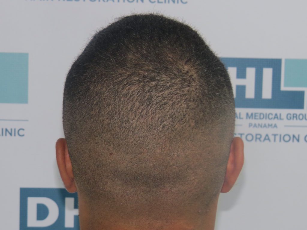 Haircuts to hide baldness - DHI Panamá