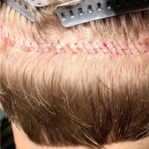 Hair Clinics - FUT Procedure Scar