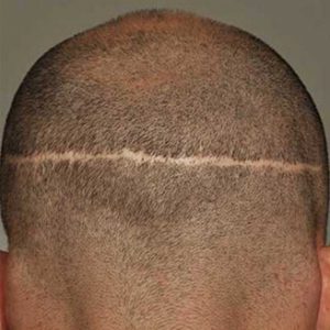Hair Clinics-FUT Scar