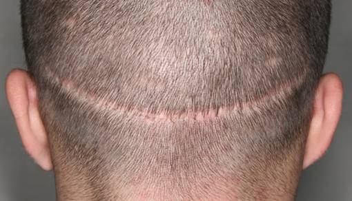 Cost of Hair Transplant - FUT Scar