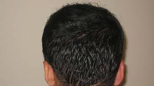 Cost of hair transplant - donor area