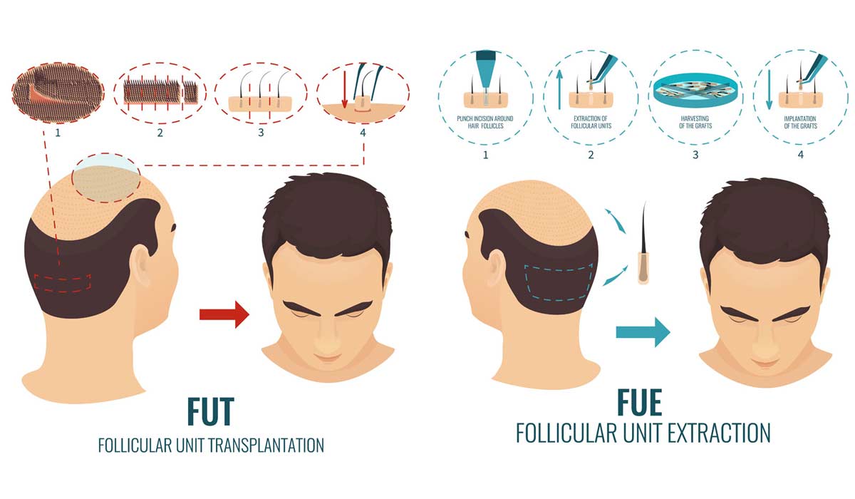 Difference between FUE & FUT Hair Transplant - DHI Panamá