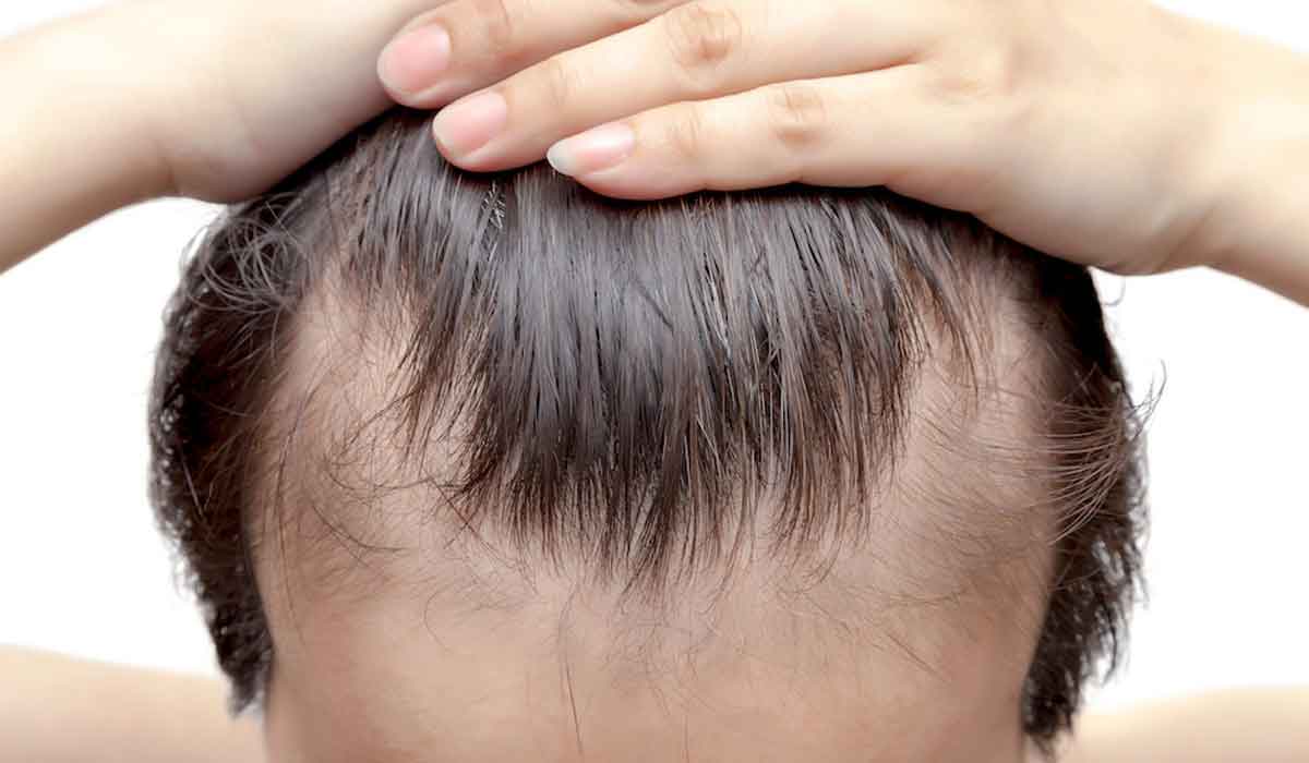 DHT y la alopecia androgénica