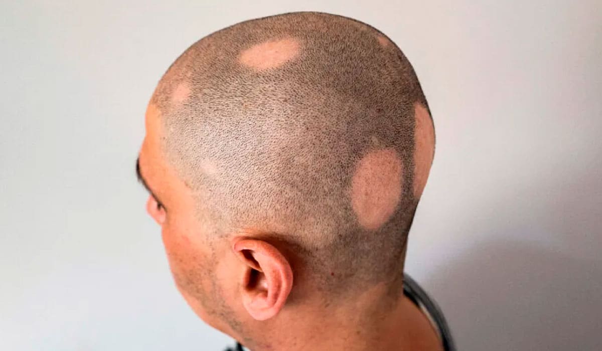All about alopecia areata - DHI Panamá
