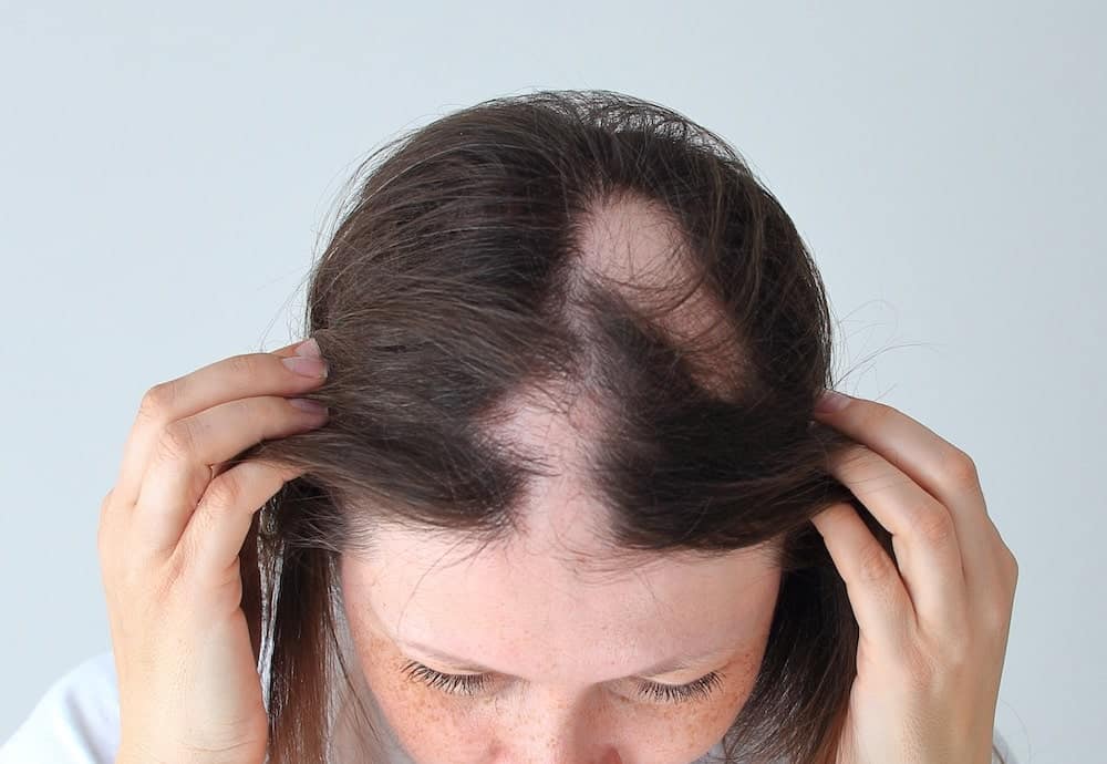 Preguntas frecuentes sobre la alopecia